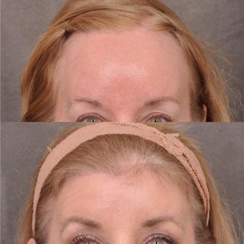 ForeheadPlasty / Hairline Lowering - Front