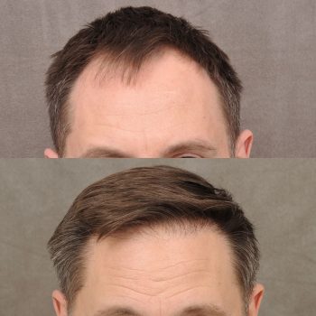 Hair Transplant Before & After Photos - Unfiltered Results Gallery
