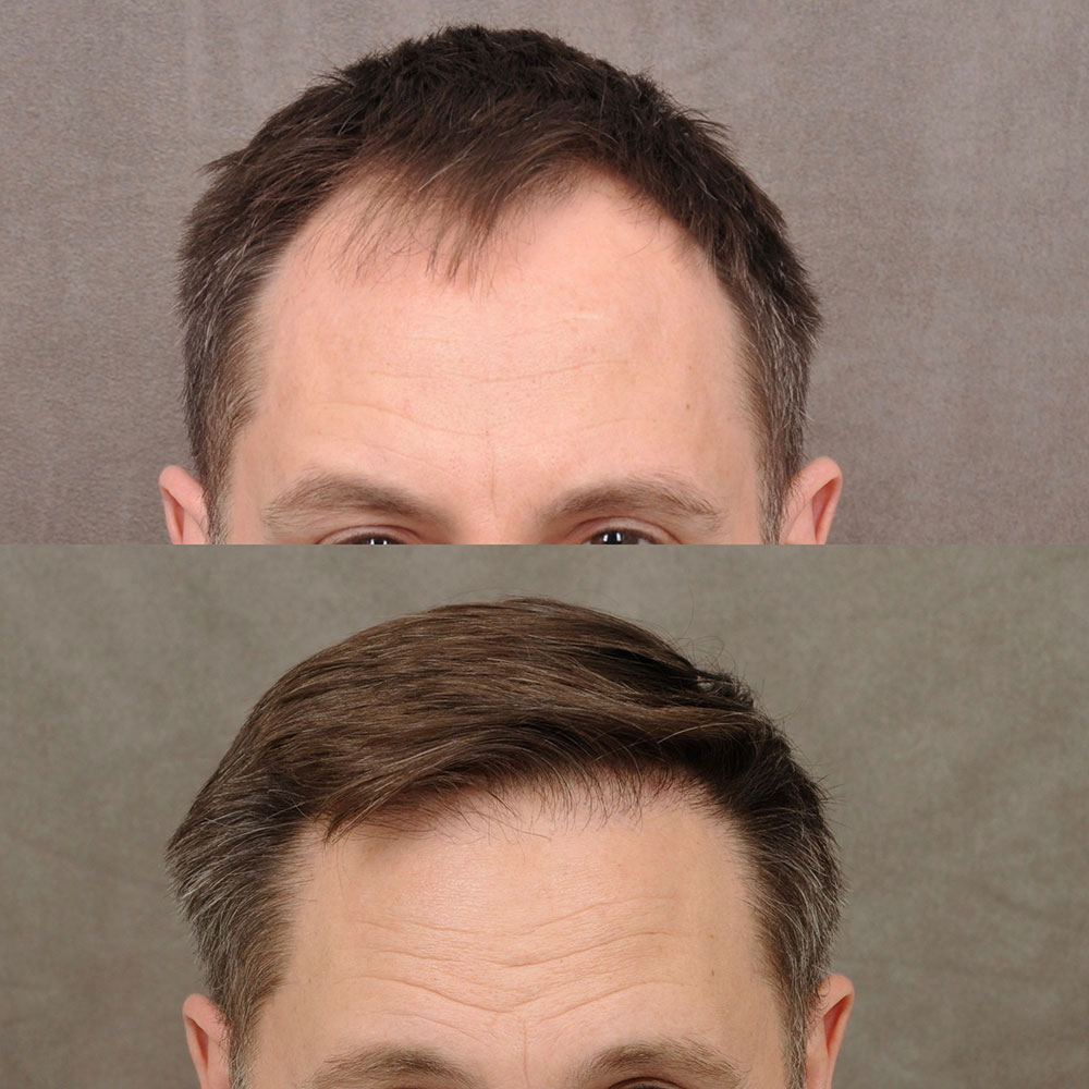 Hair Growth Before and After Pictures  Russak Aesthetic Centre  New York  City NY