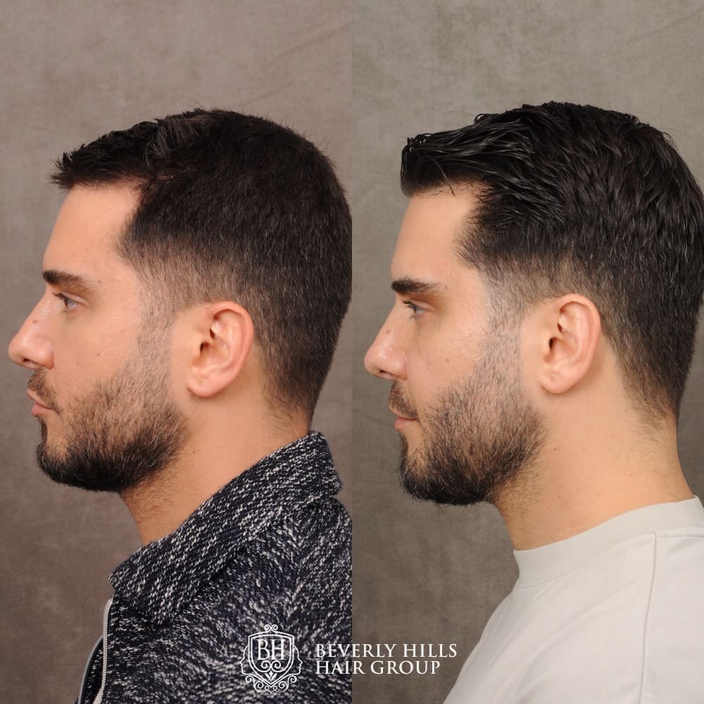 1081 Hair Transplant Before After Images Stock Photos  Vectors   Shutterstock