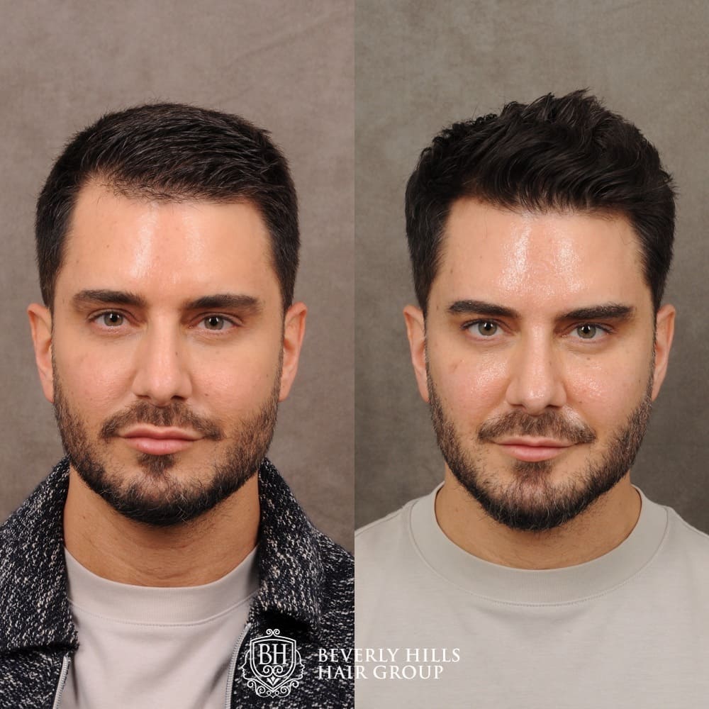 FUE Transplant Before  After  Treatment Rooms London